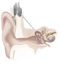Cochlea-Implantat