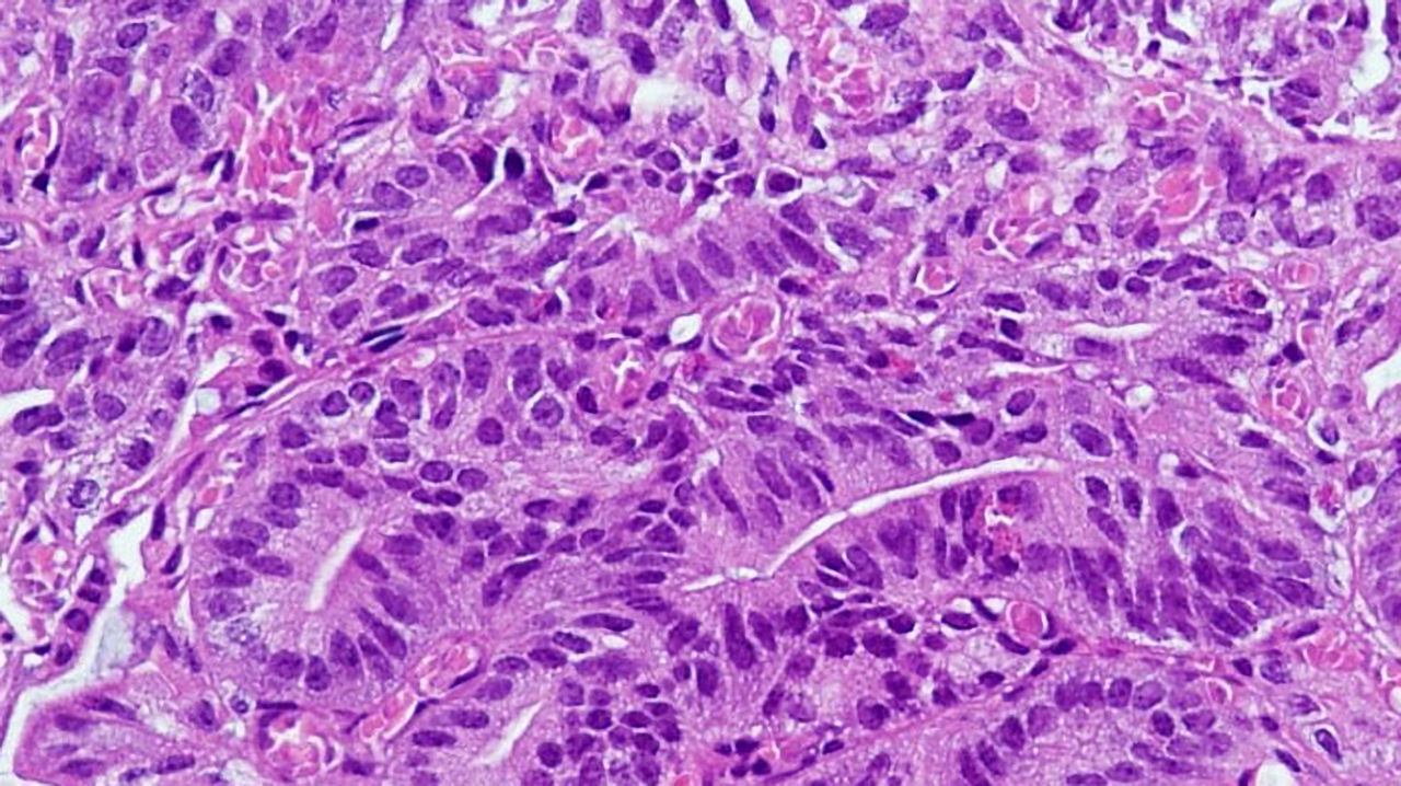 Histopathologische Aufnahmen von Tumorzellen sind ein zentraler Bestandteil der Krebsdiagnostik. (Quelle: S. Försch)